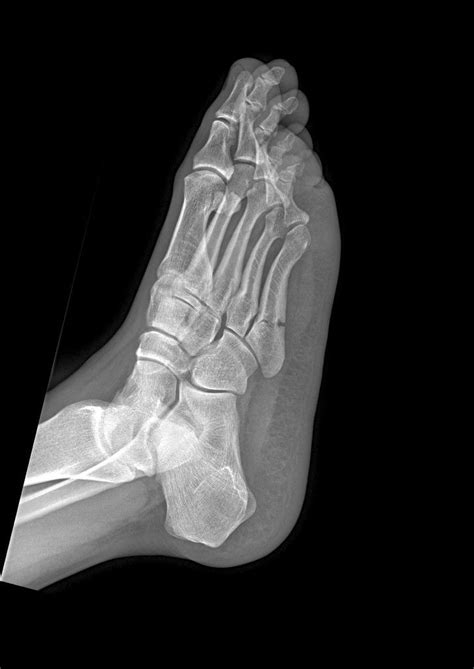 A Jones Fracture Is An Extra Articular Fracture At The Base Of The