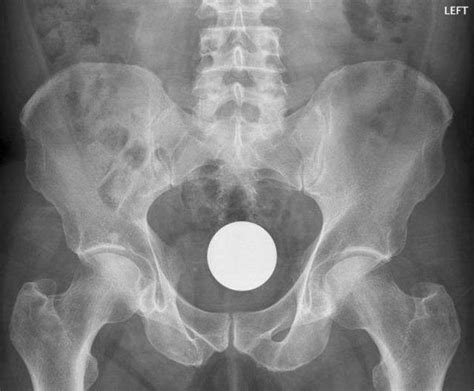 weird objects on x rays 27 pics