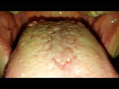 red bumps on tongue and throat bumps back of tongue and throat images