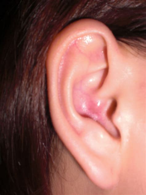 ear acne bing images