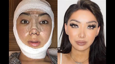 my facial plastic surgery story dragun youtube