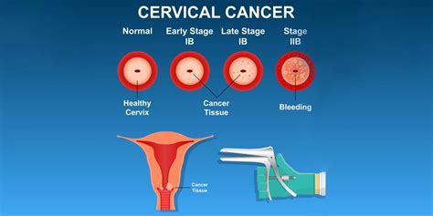 What Are Pap Smear Tests And Why Are They So Important Pristyn Care