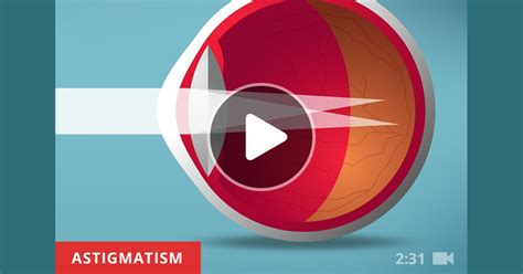 astigmatism definition symptoms causes types treatments