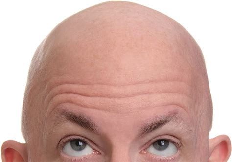 Ftestickers People Man Head Bald Baldness Hair