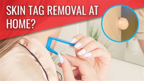 how tagband removed my skin tag youtube