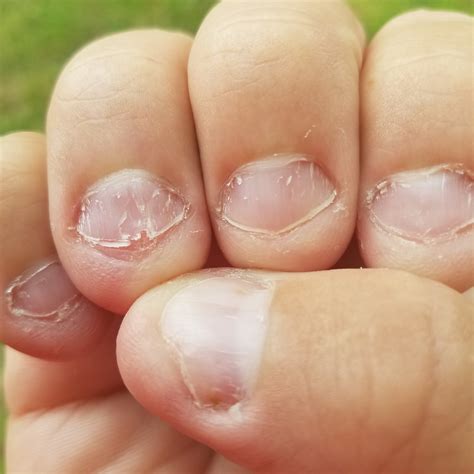 Causes Of Fingernail Fungus Forces Of Nature Medicine