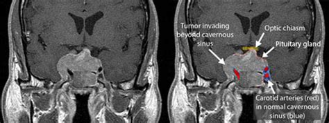 Craniopharyngioma Ucla Pituitary Tumor Program