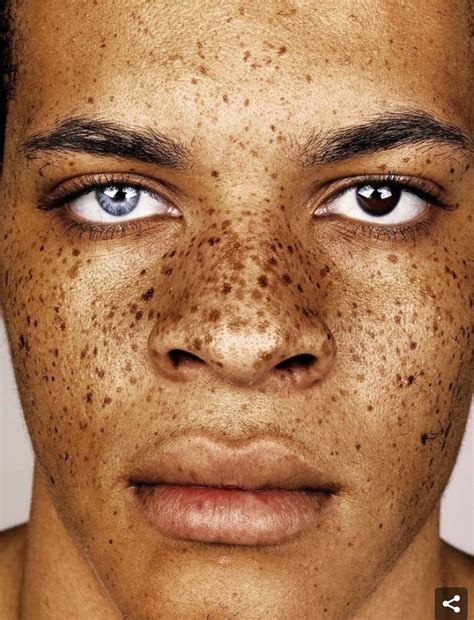 Freckled People Freckles Interesting Faces Freckle Face