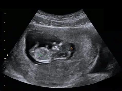 weeks pregnant symptoms fetal development ultrasound