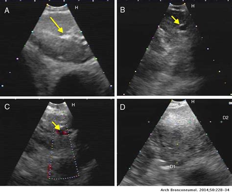 Real Time Prediction Of Mediastinal Lymph Node Malignancy By