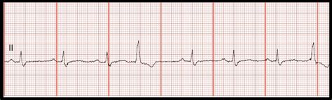 Float Nurse Practice Ekg Rhythm Strips 117