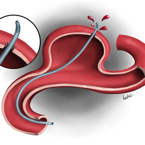 ladvic illustration aneurysm coiling complications