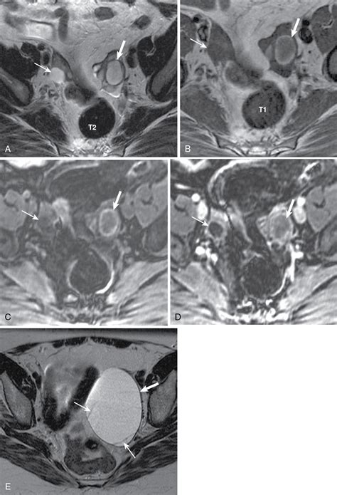 cystic adnexal lesions radiology key