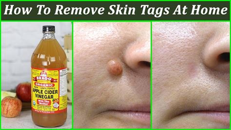 7 easy and homemade ways to remove skin tags without going to a doctor