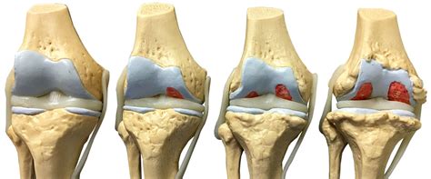 mackie orthopaedics hip  knee arthritis