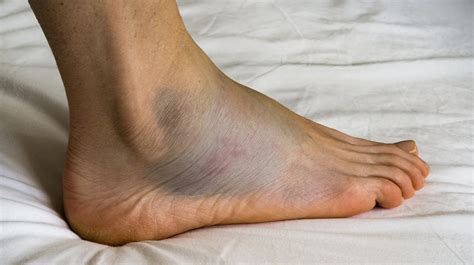 10 Causes For Swollen Feet Why Your Feet Ankles Legs Swell Ph