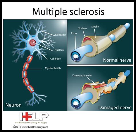multiple sclerosis nervous system pinterest