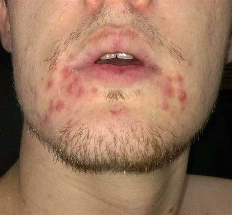 breaking     lip painful red raised bumps