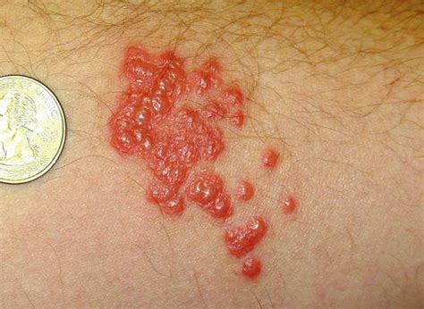 Bed Bug Blisters Images Bangdodo