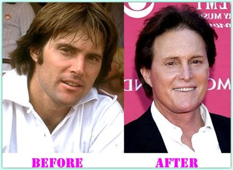 69 best celebrities plastic surgery before and after images on