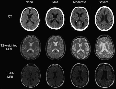 Ct And T2 Weighted Mri Showing Leukoaraiosis At Different Stages Of