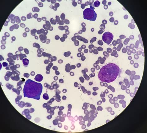 pure red cell aplasia  hiv infection   suspect bmj case