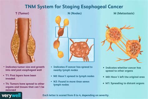 Esophageal Cancer Staging Grades Staging Prognosis