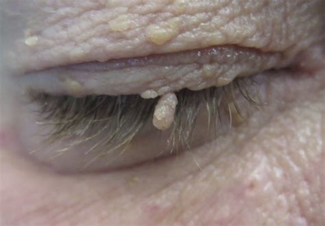 eyelid lumps  bumps benign eyelid lesions saul rajak ophthalmology