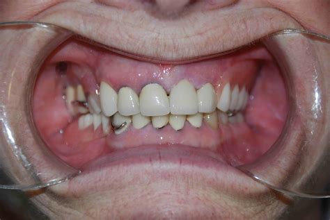 dentures  avenue dental