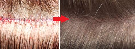 hair transplant leave  scar feller bloxham medical