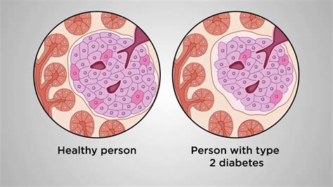 Beyond Glucose A Beta Cell Centric Approach To Prevent Type 2 Diabetes
