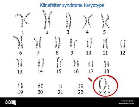Klinefelter Syndrom Karyotyp Stockfotografie Alamy