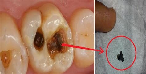wow obat mujarab sakit gigi tradisional sampai keluar ulat dari gigi ini cara qu