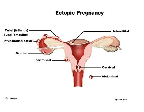 ectopic pregnancy usmle strike