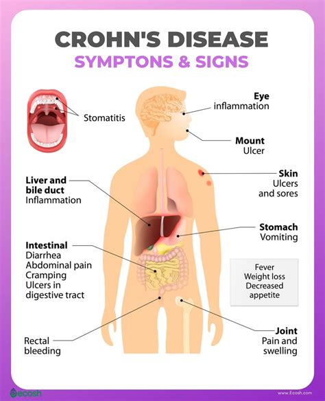 crohns disease symptoms  risk factors crohns disease diet