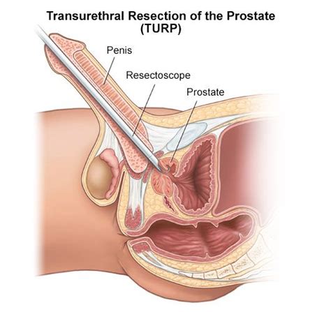 Sexual effects of prostate removal