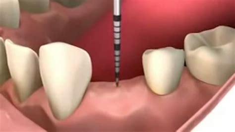 quanto custa fazer implante dentário consulta ideal