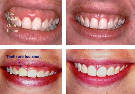 gummy smile treatment long island esthetic gum contouring