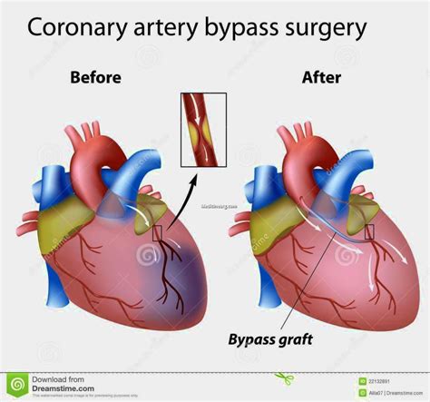 heart bypass surgery medicinebtgcom