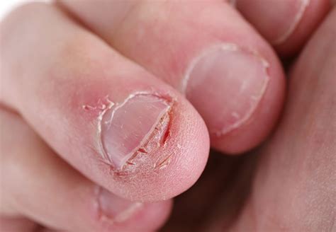 the health risks of biting your nails