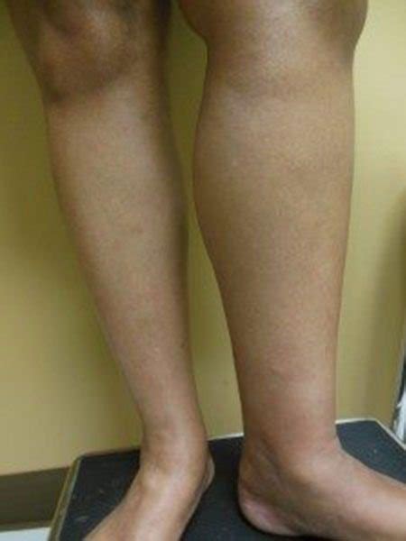 leg swelling tampa leg pain tampa