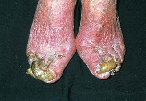 deformed toenails photograph by dr p marazzi science photo library