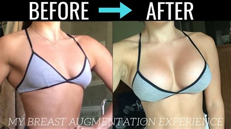 my breast augmentation experience process recovery and details youtube