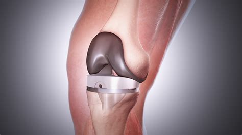 Knee Replacement Surgery The Most Popular Orthopedic Procedure