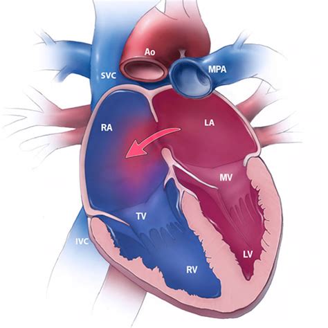 structural heart defects teachmepaediatrics