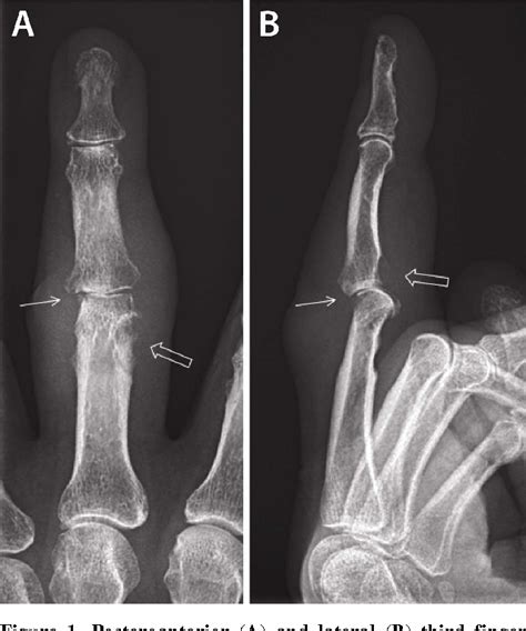 figure    pathognomic radiologic features  gout