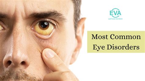Exploring Common Eye Disorders Understanding And Seeking Treatment