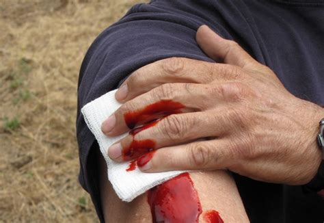 First Aid For Bleeding How To Stop The Bleed Major Bleeding Control