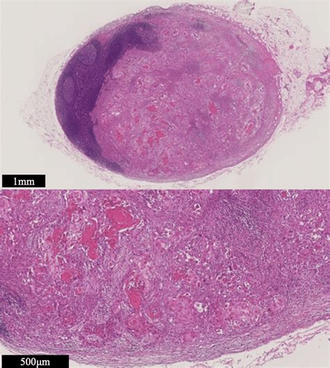 Pathological Finding Of Lingual Lymph Node Metastasis Hematoxylin And