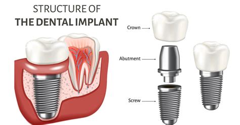 tooth implant cost  singapore read   find